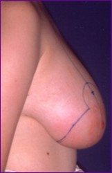 Breast reduction before surgery